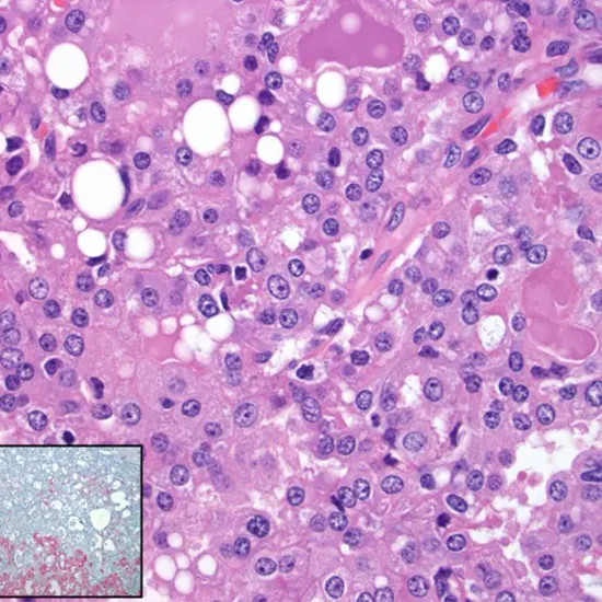 mammary secretory carcinoma